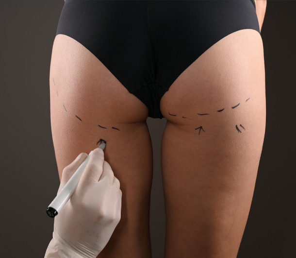 Surgical planning for thigh contouring